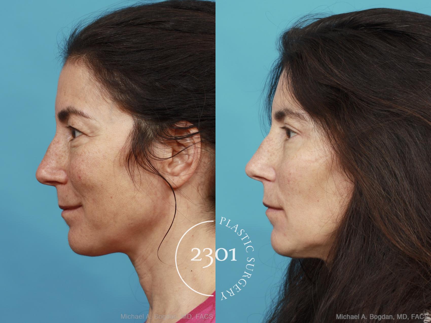 Before & After Blepharoplasty Case 444 View #2 View in Fort Worth, Plano, & Frisco, Texas