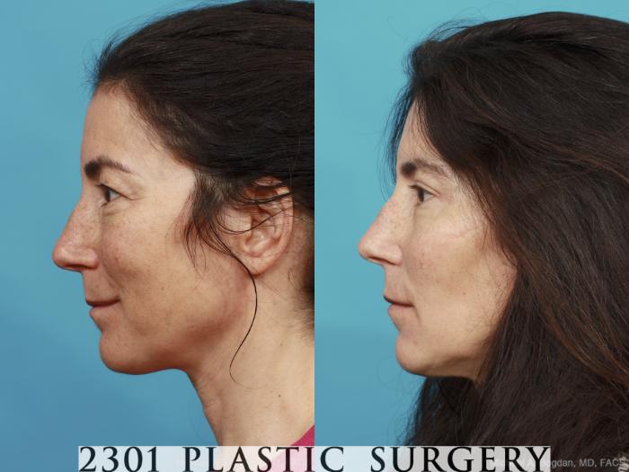 Before & After Blepharoplasty Case 444 View #2 View in Fort Worth, Plano, & Frisco, Texas