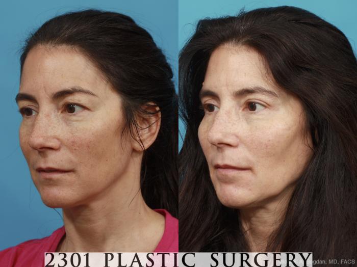 Before & After Blepharoplasty Case 444 View #3 View in Fort Worth, Plano, & Frisco, Texas