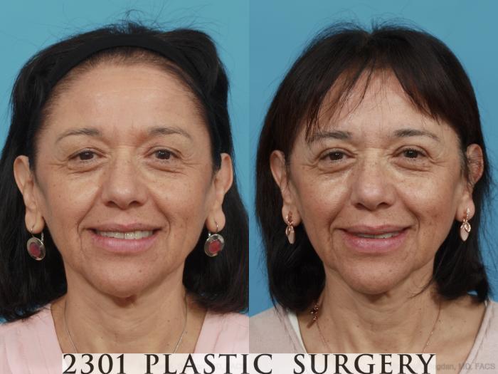 Before & After Blepharoplasty Case 465 View #1 View in Fort Worth, Plano, & Frisco, Texas