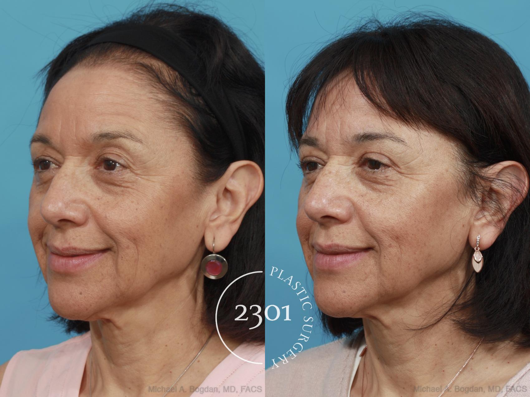 Before & After Blepharoplasty Case 465 View #2 View in Fort Worth, Plano, & Frisco, Texas