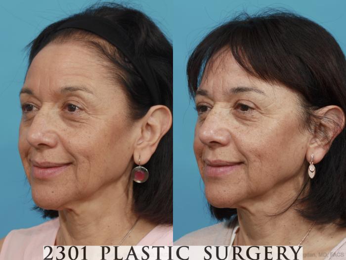 Before & After Blepharoplasty Case 465 View #2 View in Fort Worth, Plano, & Frisco, Texas