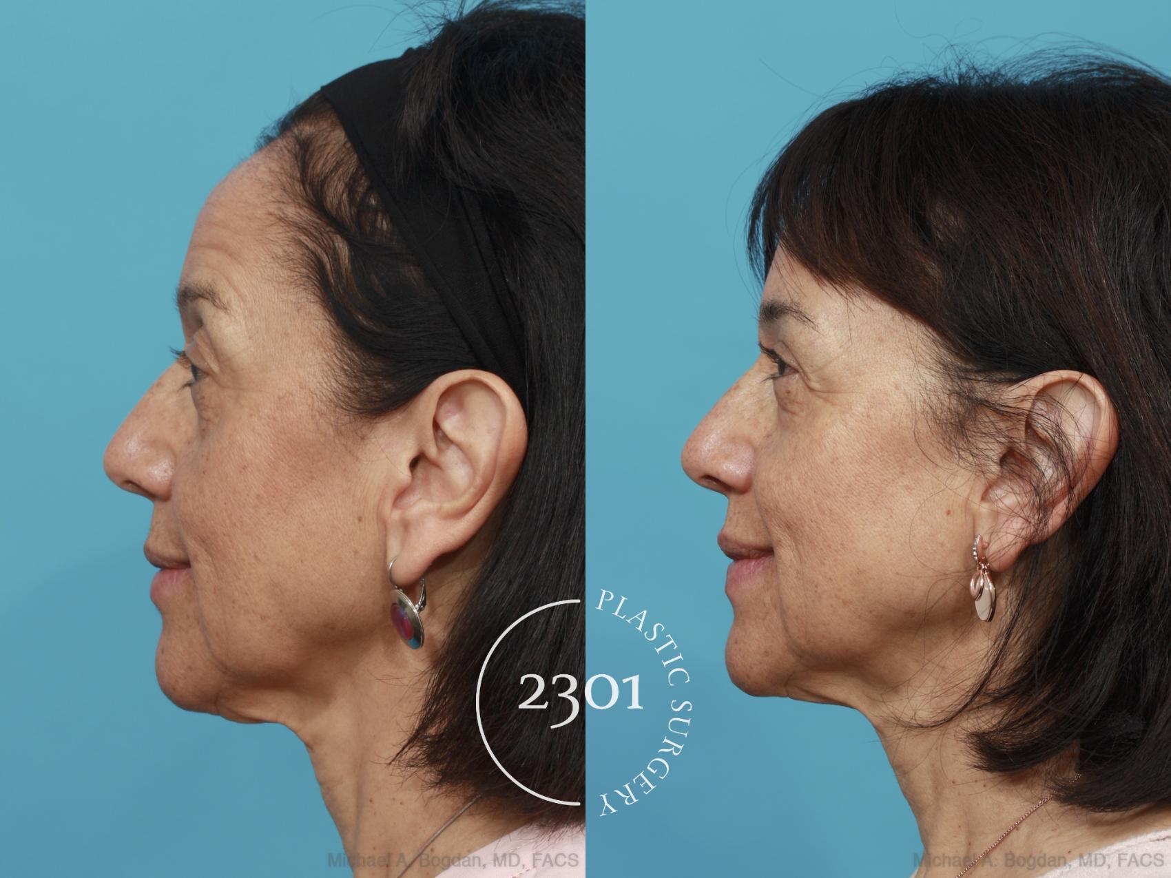 Before & After Blepharoplasty Case 465 View #3 View in Fort Worth, Plano, & Frisco, Texas