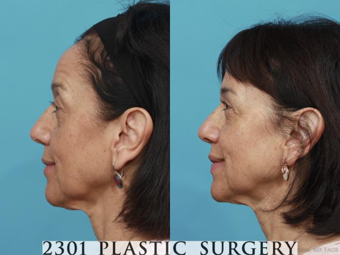 Before & After Blepharoplasty Case 465 View #3 View in Fort Worth, Plano, & Frisco, Texas