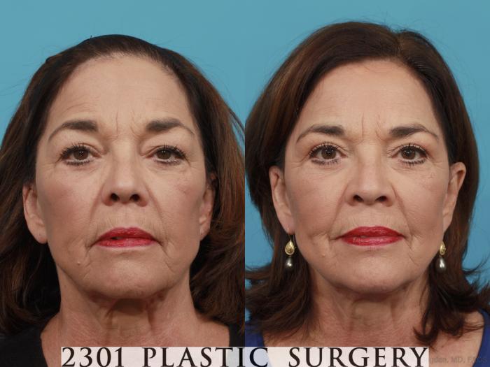 Before & After Blepharoplasty Case 466 View #1 View in Fort Worth, Plano, & Frisco, Texas