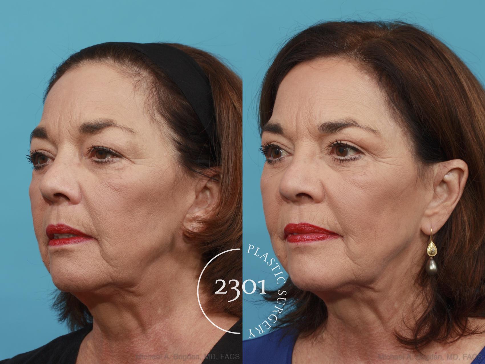 Before & After Blepharoplasty Case 466 View #2 View in Fort Worth, Plano, & Frisco, Texas