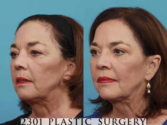 Before & After Blepharoplasty Case 466 View #2 View in Fort Worth, Plano, & Frisco, Texas