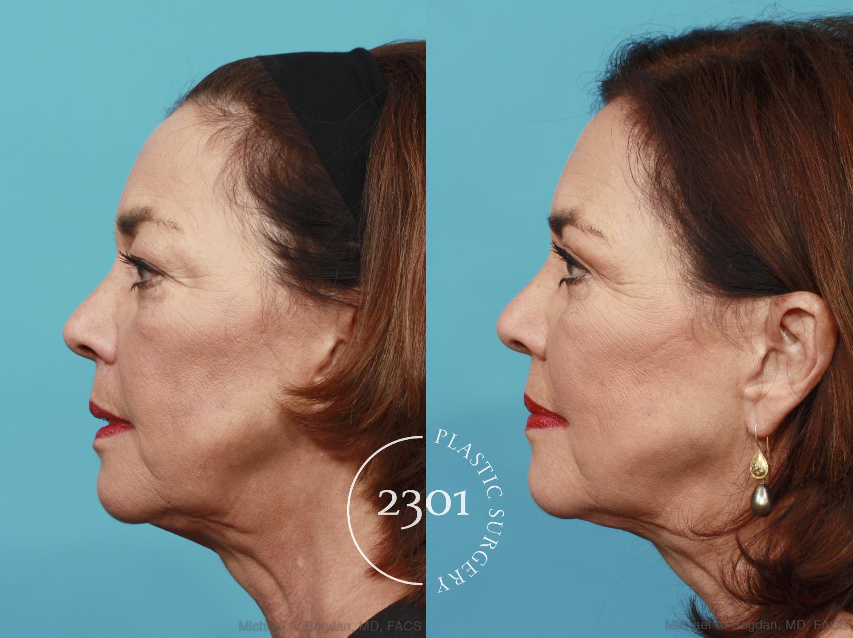 Before & After Blepharoplasty Case 466 View #3 View in Fort Worth, Plano, & Frisco, Texas