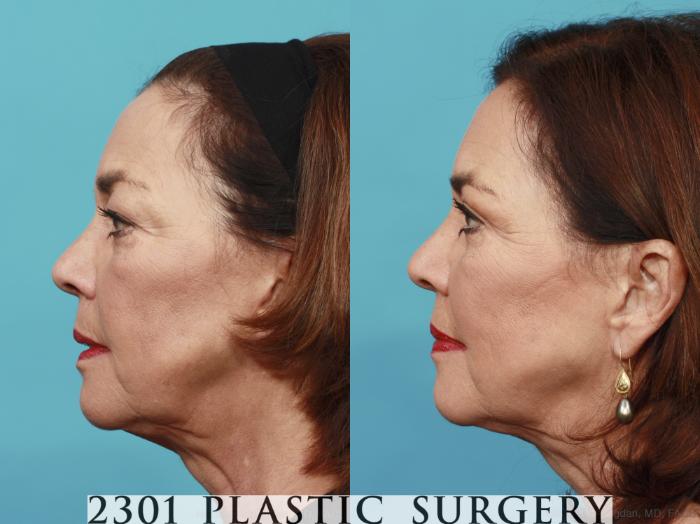Before & After Blepharoplasty Case 466 View #3 View in Fort Worth, Plano, & Frisco, Texas