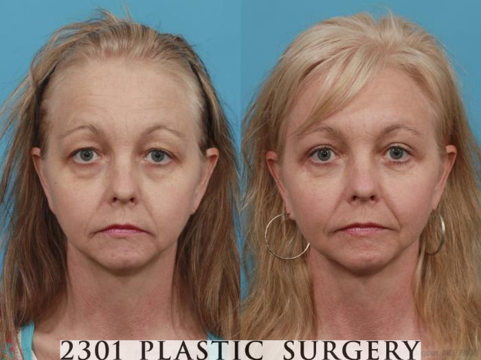 Before & After Blepharoplasty Case 476 View #1 View in Fort Worth, Plano, & Frisco, Texas
