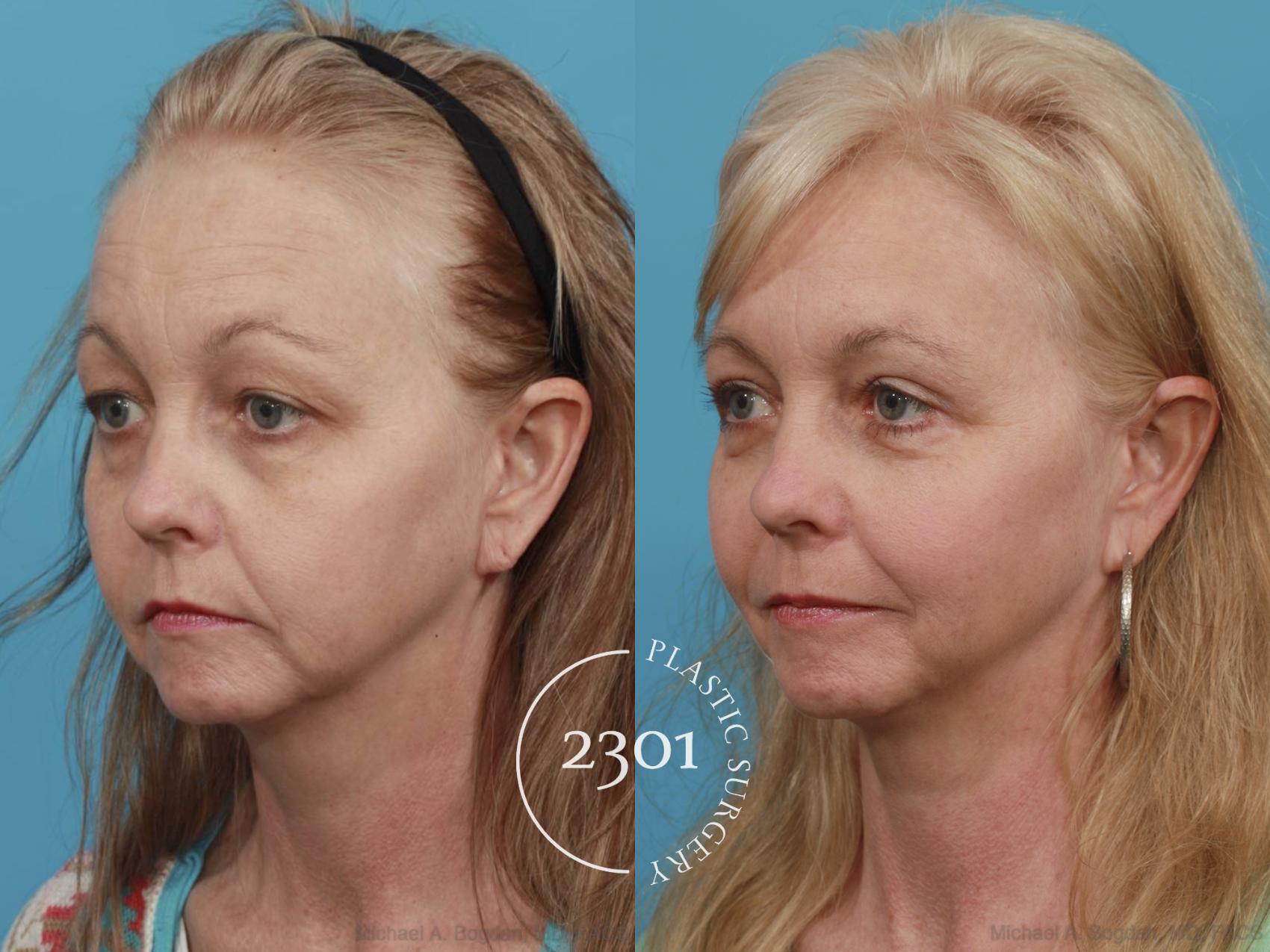 Before & After Eyelid Surgery (Upper) Case 476 View #2 View in Fort Worth, Plano, & Frisco, Texas