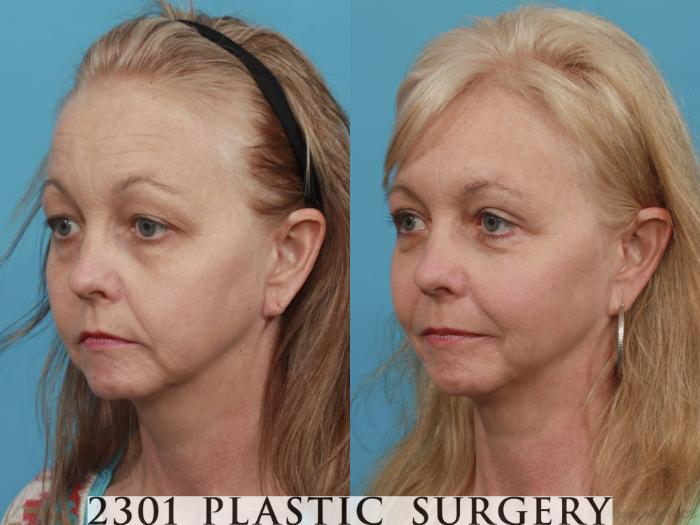 Before & After Eyelid Surgery (Upper) Case 476 View #2 View in Fort Worth, Plano, & Frisco, Texas
