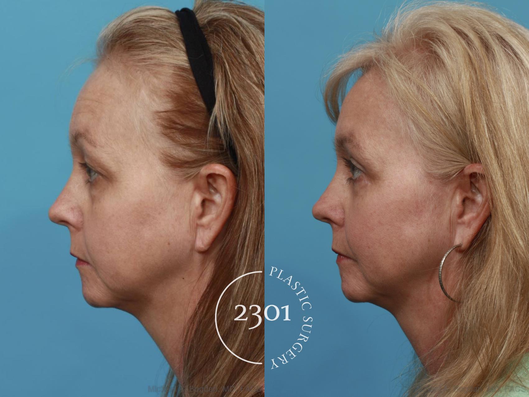 Before & After Eyelid Surgery (Upper) Case 476 View #3 View in Fort Worth, Plano, & Frisco, Texas