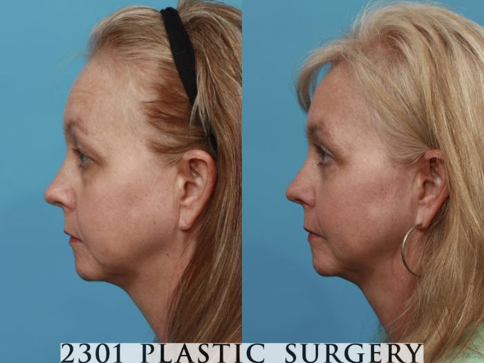Before & After Eyelid Surgery (Upper) Case 476 View #3 View in Fort Worth, Plano, & Frisco, Texas
