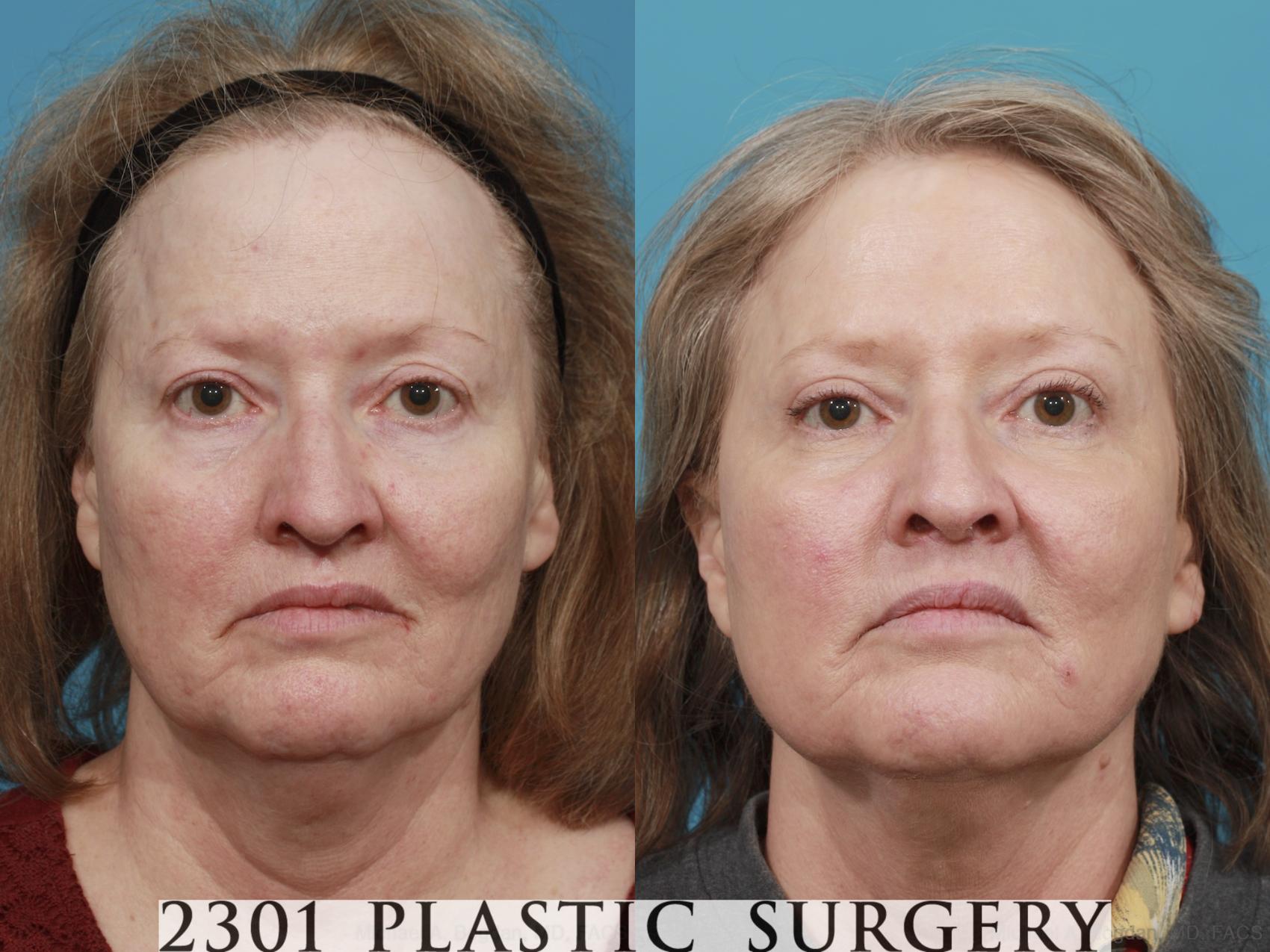Before & After Blepharoplasty Case 482 View #1 View in Fort Worth & Frisco, Texas