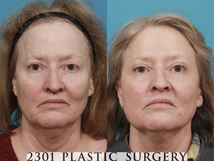 Before & After Blepharoplasty Case 482 View #1 View in Fort Worth, Plano, & Frisco, Texas