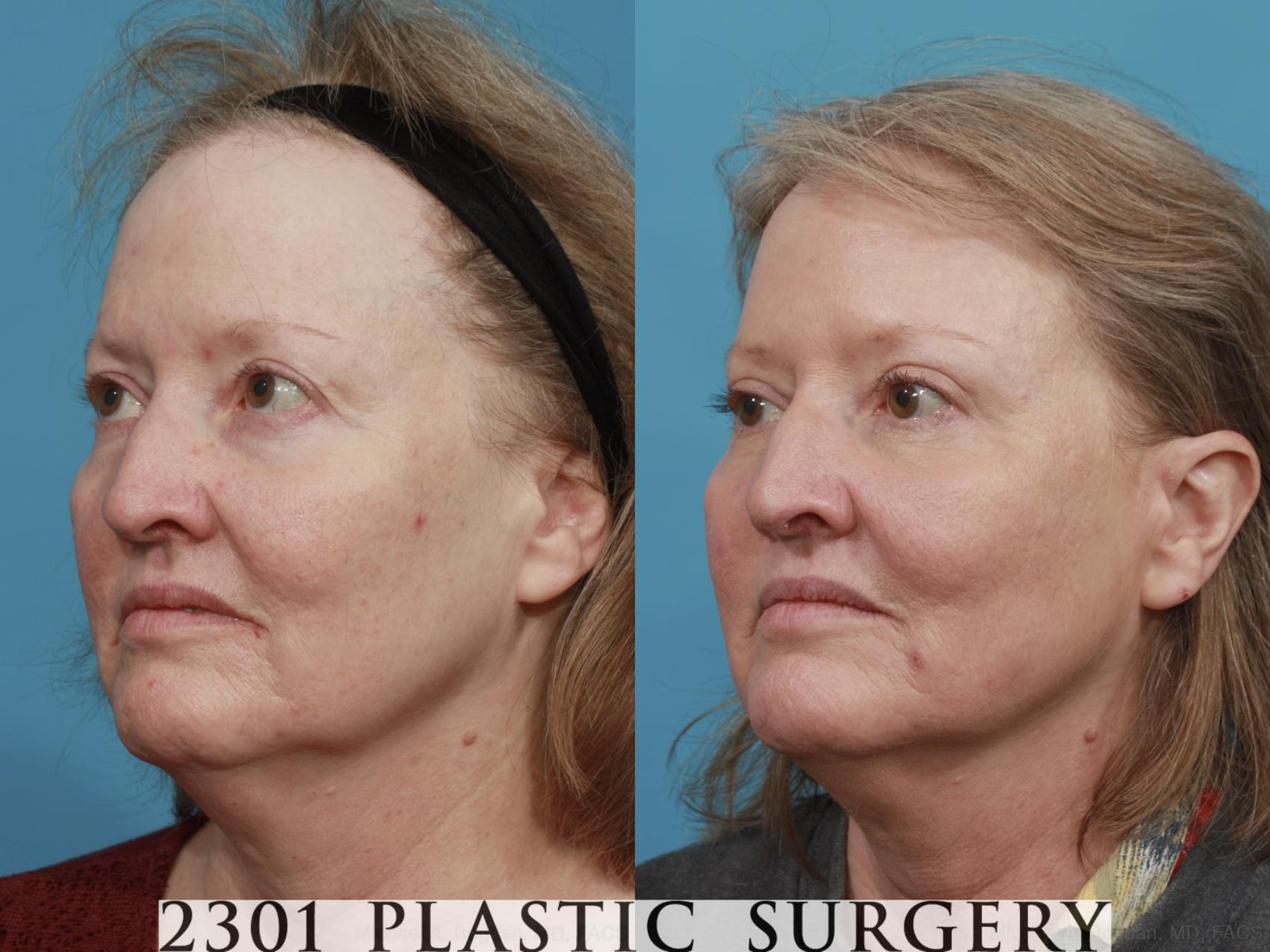 Before & After Blepharoplasty Case 482 View #2 View in Fort Worth & Frisco, Texas