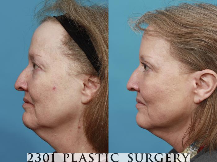 Before & After Blepharoplasty Case 482 View #3 View in Fort Worth, Plano, & Frisco, Texas