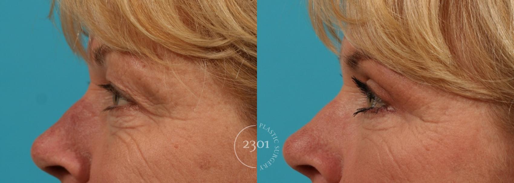 Before & After Blepharoplasty Case 50 View #2 View in Fort Worth, Plano, & Frisco, Texas