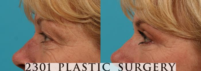 Before & After Blepharoplasty Case 50 View #2 View in Fort Worth, Plano, & Frisco, Texas