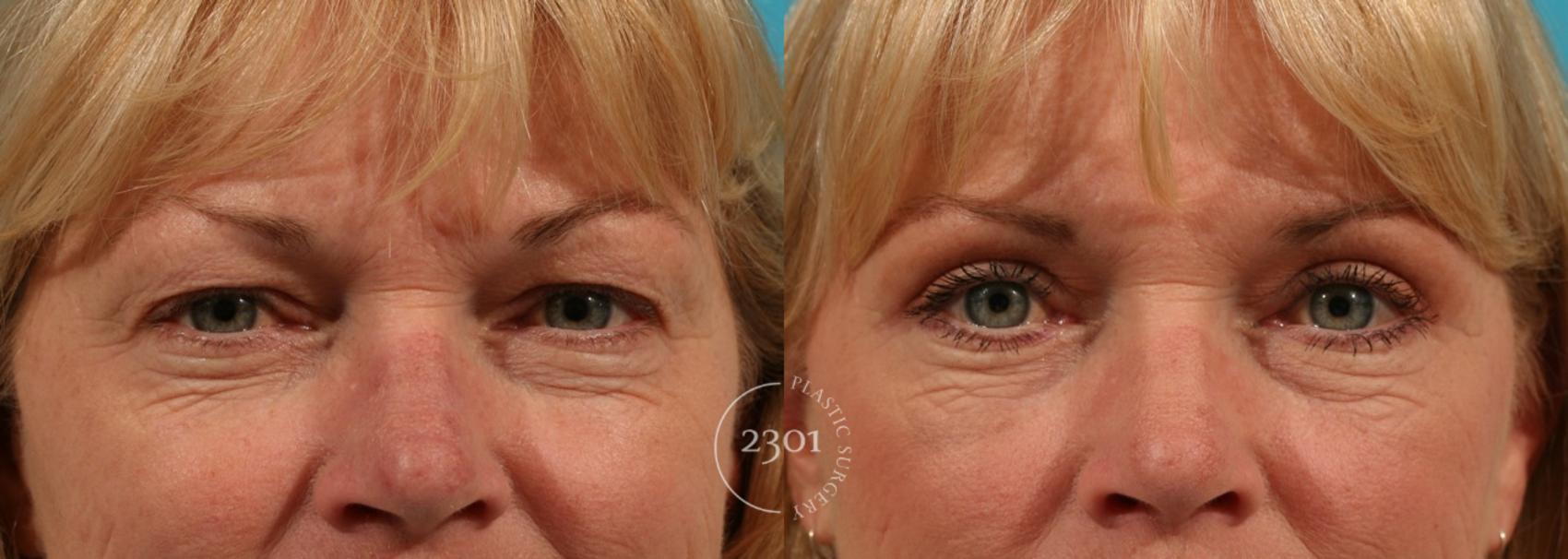 Before & After Blepharoplasty Case 50 View #3 View in Fort Worth, Plano, & Frisco, Texas