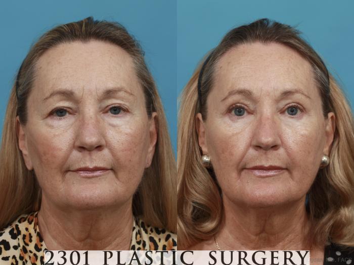 Before & After Blepharoplasty Case 502 View #1 View in Fort Worth & Frisco, Texas
