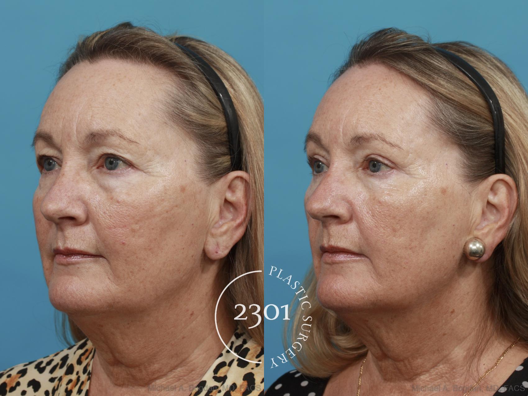 Before & After Blepharoplasty Case 502 View #2 View in Fort Worth, Plano, & Frisco, Texas