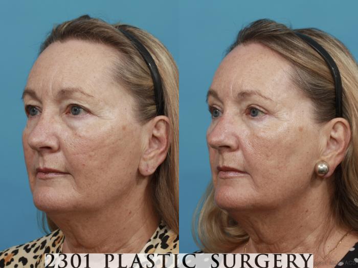 Before & After Blepharoplasty Case 502 View #2 View in Fort Worth, Plano, & Frisco, Texas