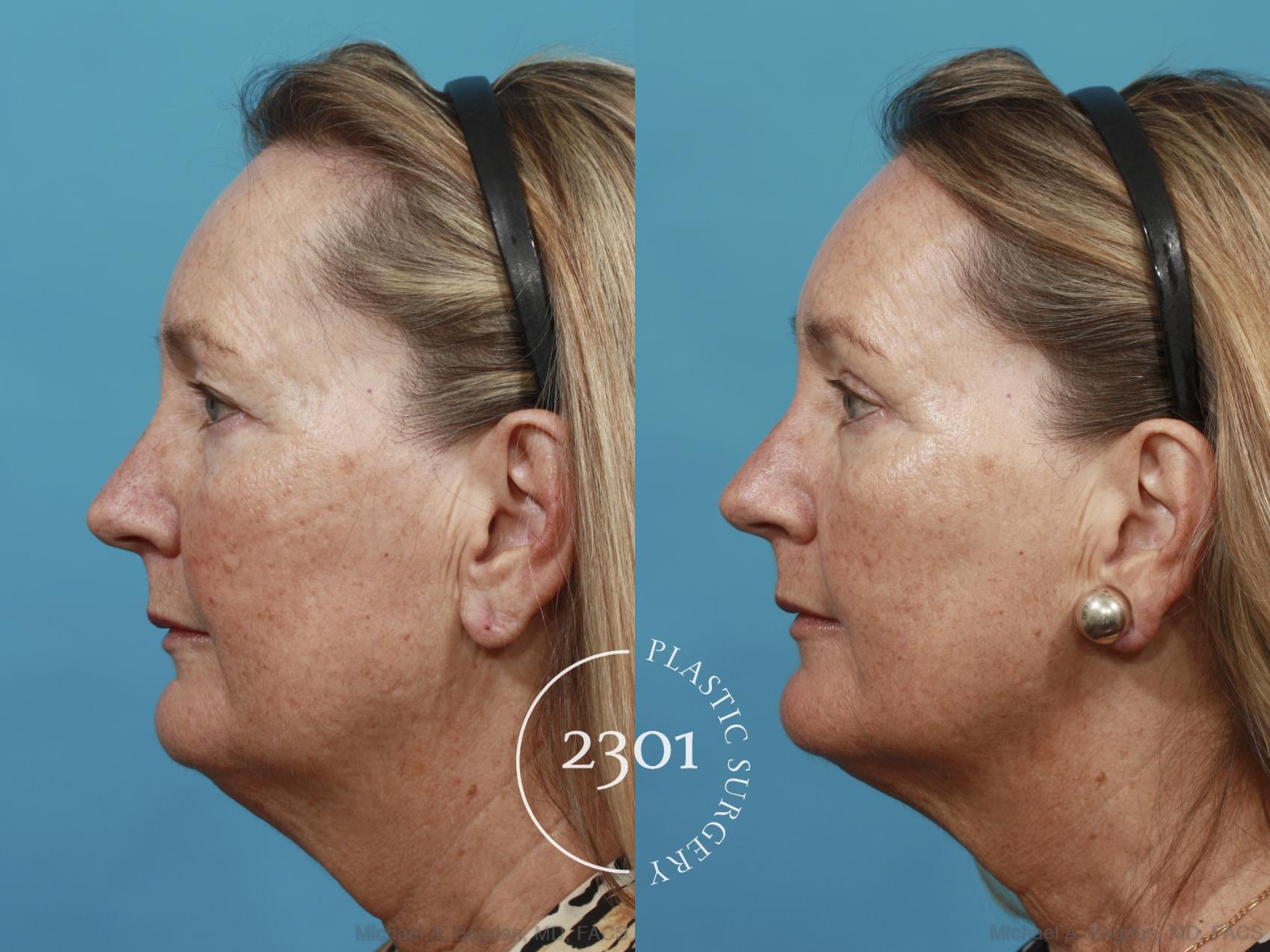 Before & After Blepharoplasty Case 502 View #3 View in Fort Worth, Plano, & Frisco, Texas