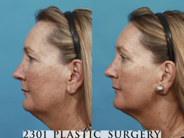 Before & After Blepharoplasty Case 502 View #3 View in Fort Worth, Plano, & Frisco, Texas