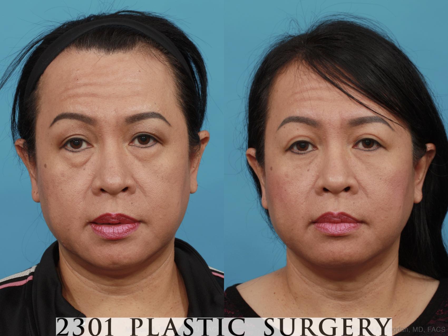 Before & After Blepharoplasty Case 524 View #1 View in Fort Worth, Plano, & Frisco, Texas