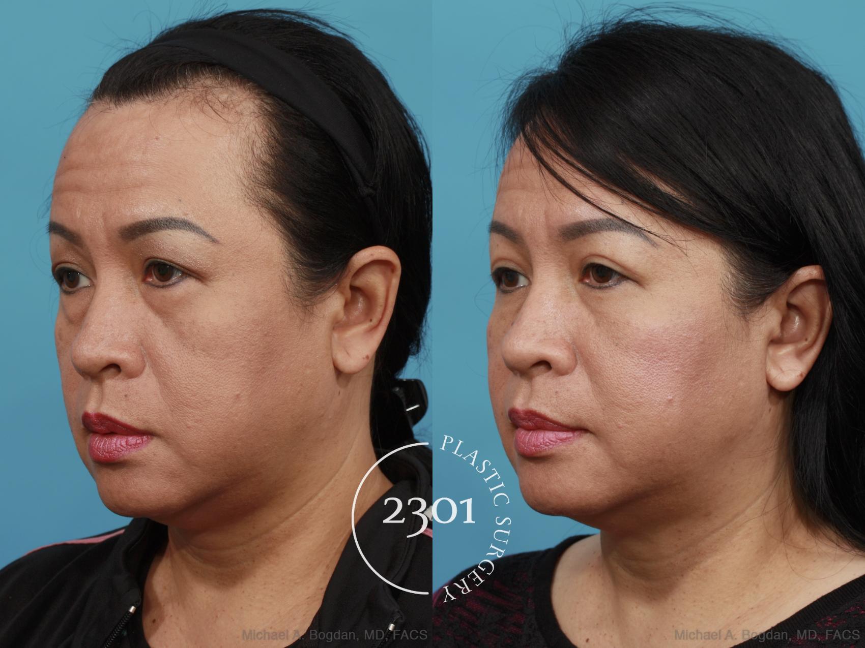 Before & After Blepharoplasty Case 524 View #2 View in Fort Worth, Plano, & Frisco, Texas
