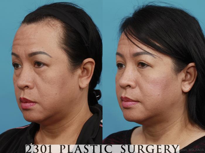 Before & After Blepharoplasty Case 524 View #2 View in Fort Worth, Plano, & Frisco, Texas