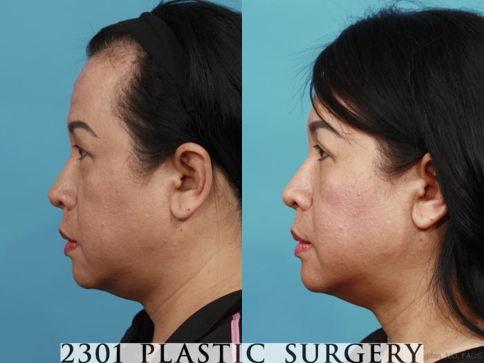 Before & After Blepharoplasty Case 524 View #3 View in Fort Worth, Plano, & Frisco, Texas