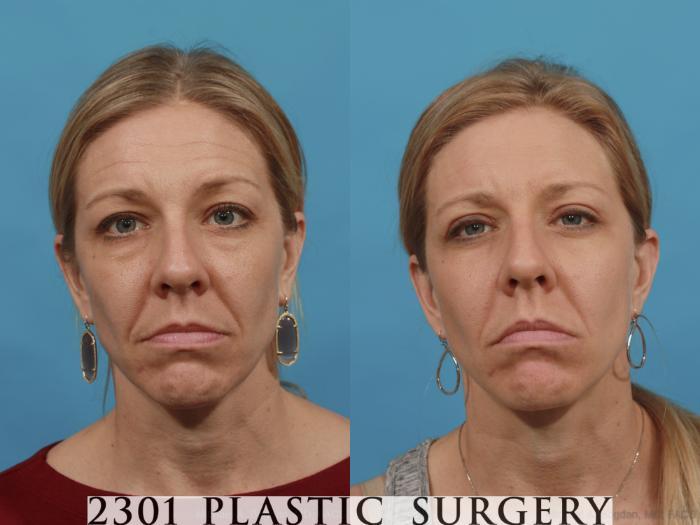 Before & After Blepharoplasty Case 543 View #1 View in Fort Worth, Plano, & Frisco, Texas