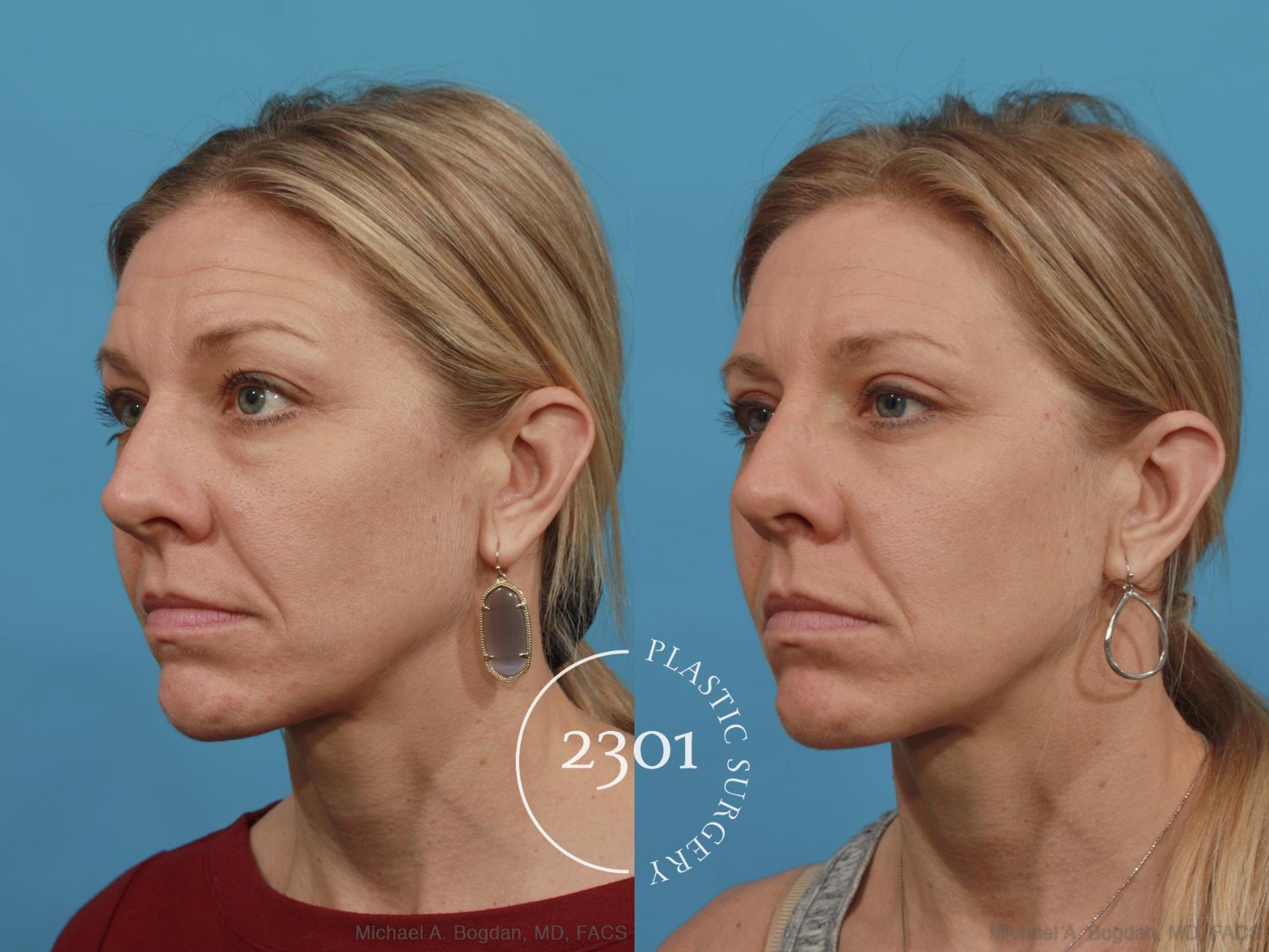 Before & After Blepharoplasty Case 543 View #2 View in Fort Worth, Plano, & Frisco, Texas