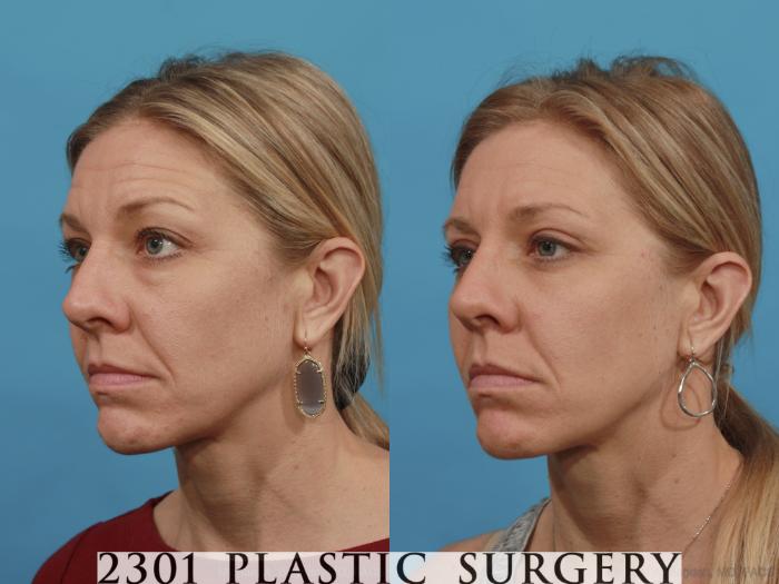 Before & After Blepharoplasty Case 543 View #2 View in Fort Worth, Plano, & Frisco, Texas
