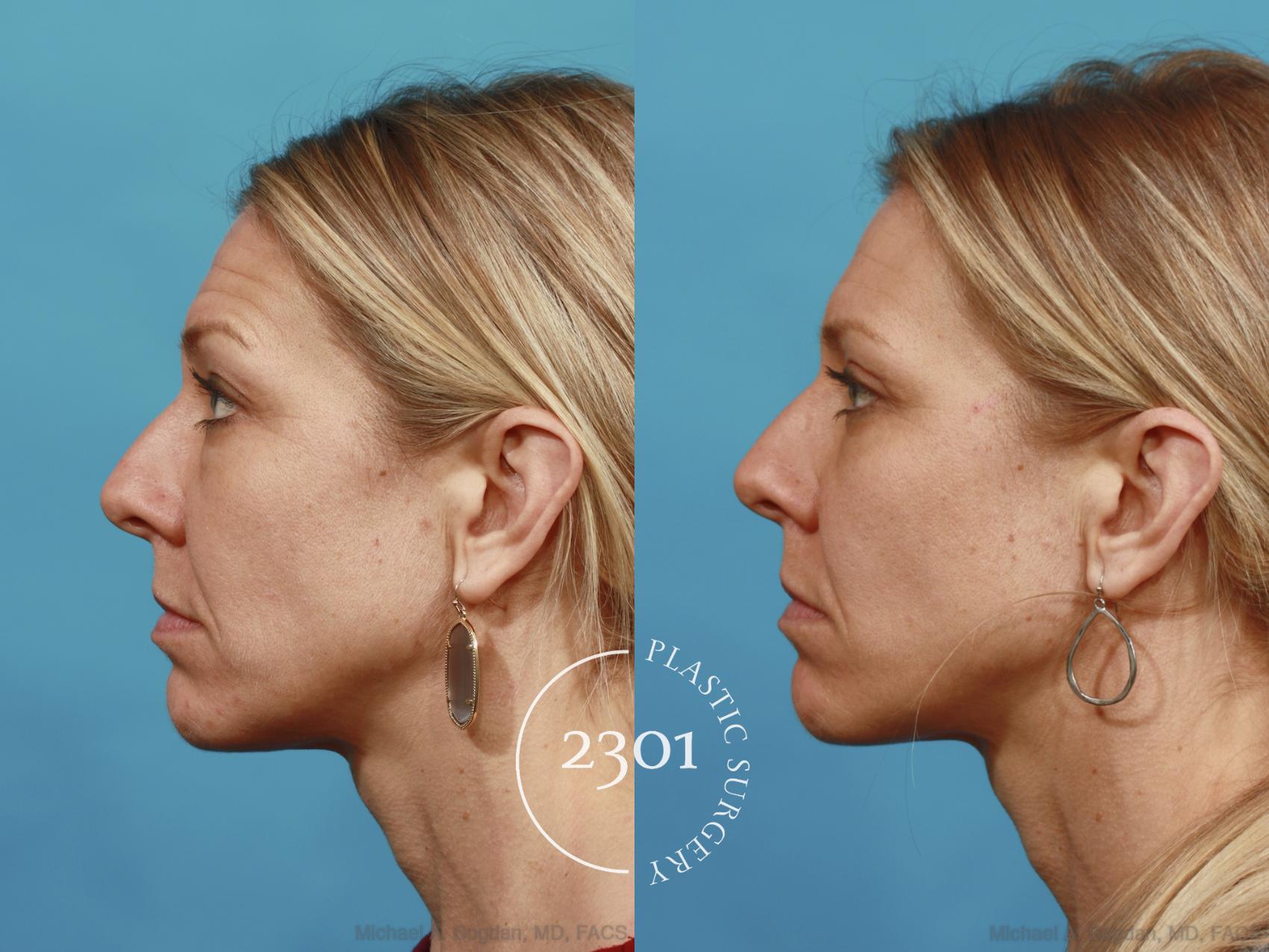 Before & After Blepharoplasty Case 543 View #3 View in Fort Worth, Plano, & Frisco, Texas