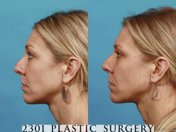 Before & After Blepharoplasty Case 543 View #3 View in Fort Worth, Plano, & Frisco, Texas