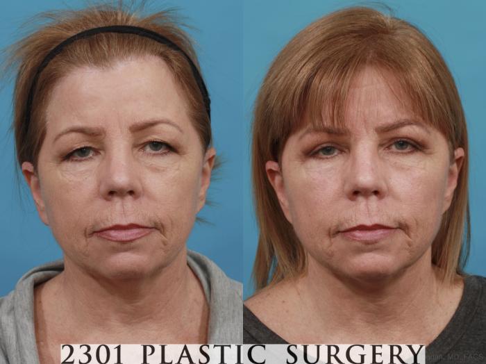 Before & After Blepharoplasty Case 544 View #1 View in Fort Worth, Plano, & Frisco, Texas