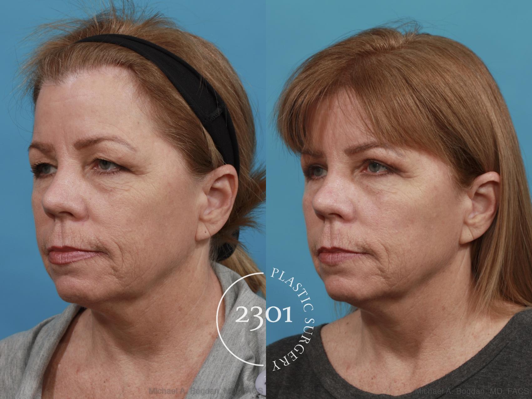 Before & After Blepharoplasty Case 544 View #2 View in Fort Worth, Plano, & Frisco, Texas