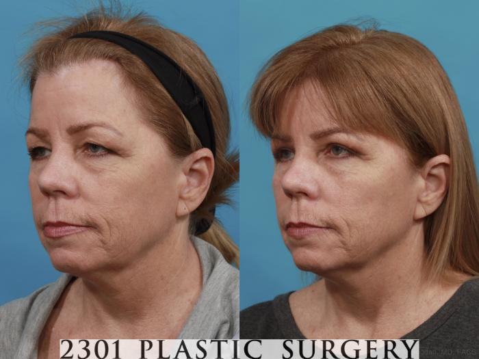 Before & After Blepharoplasty Case 544 View #2 View in Fort Worth, Plano, & Frisco, Texas