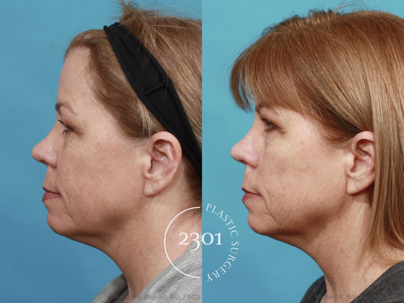 Before & After Blepharoplasty Case 544 View #3 View in Fort Worth, Plano, & Frisco, Texas