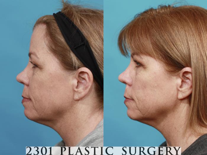 Before & After Blepharoplasty Case 544 View #3 View in Fort Worth, Plano, & Frisco, Texas