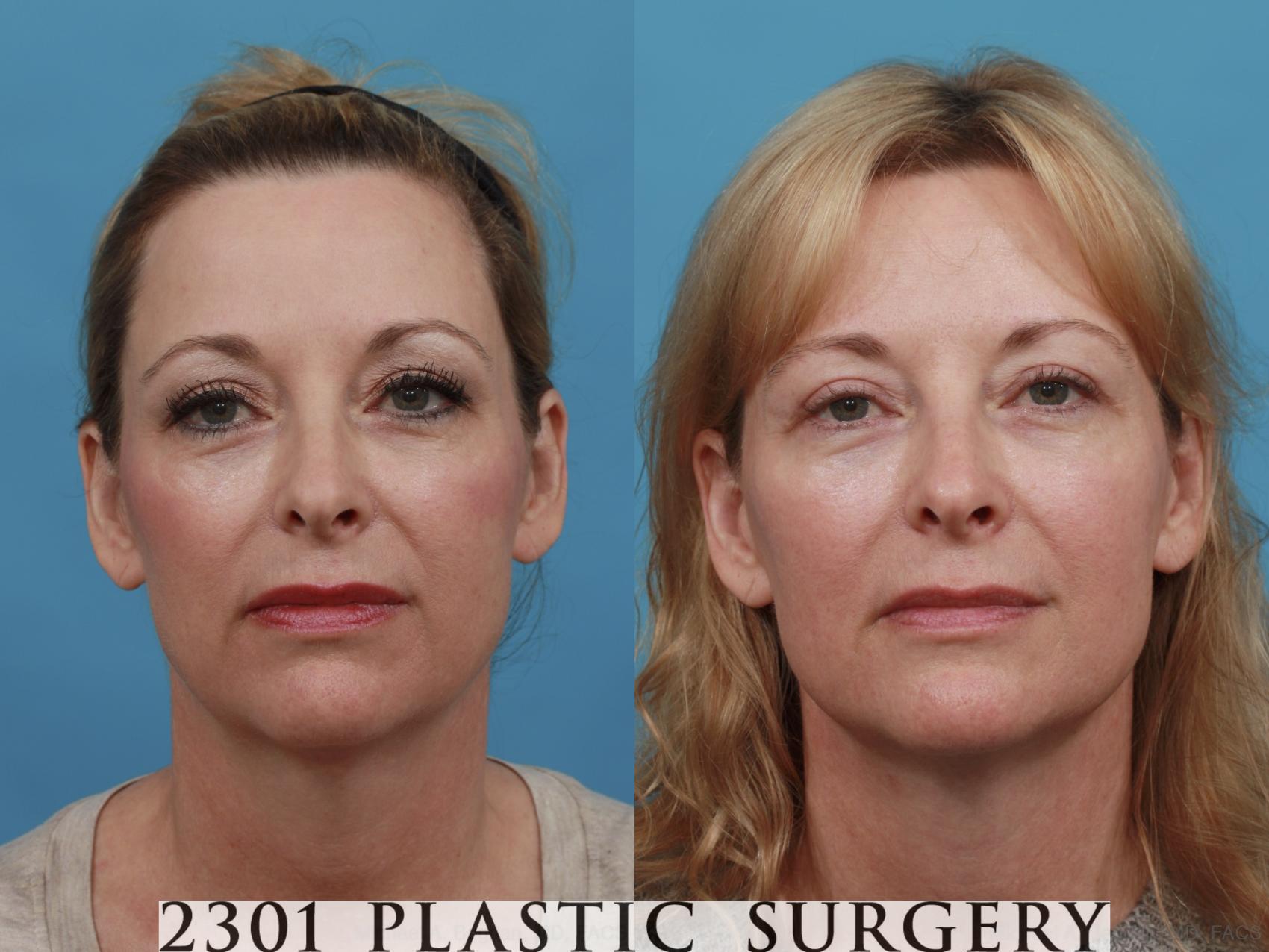 Before & After Blepharoplasty Case 545 View #1 View in Fort Worth, Plano, & Frisco, Texas
