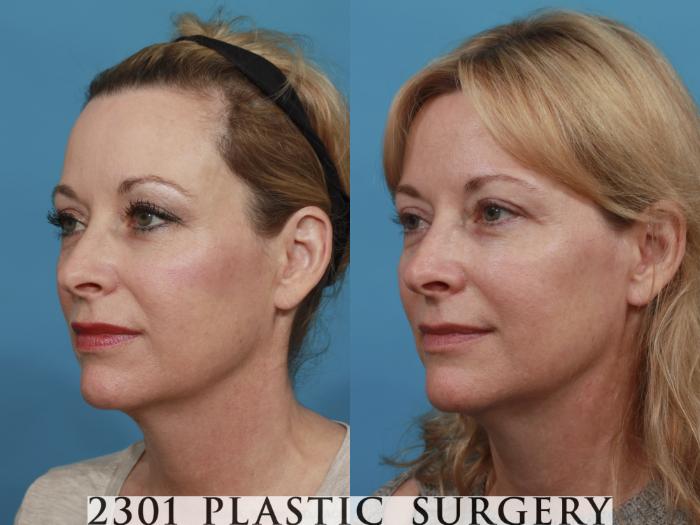 Before & After Blepharoplasty Case 545 View #2 View in Fort Worth, Plano, & Frisco, Texas