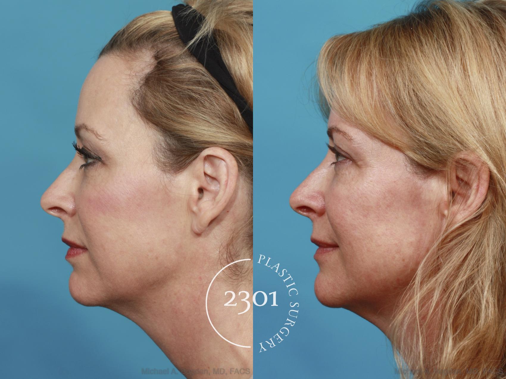 Before & After Blepharoplasty Case 545 View #3 View in Fort Worth, Plano, & Frisco, Texas