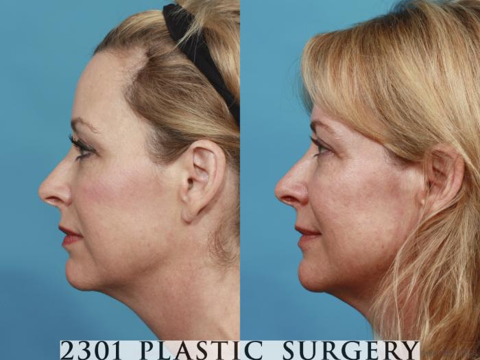 Before & After Blepharoplasty Case 545 View #3 View in Fort Worth, Plano, & Frisco, Texas