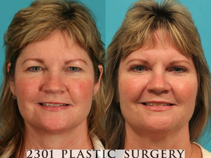 Before & After Blepharoplasty Case 55 View #1 View in Fort Worth, Plano, & Frisco, Texas