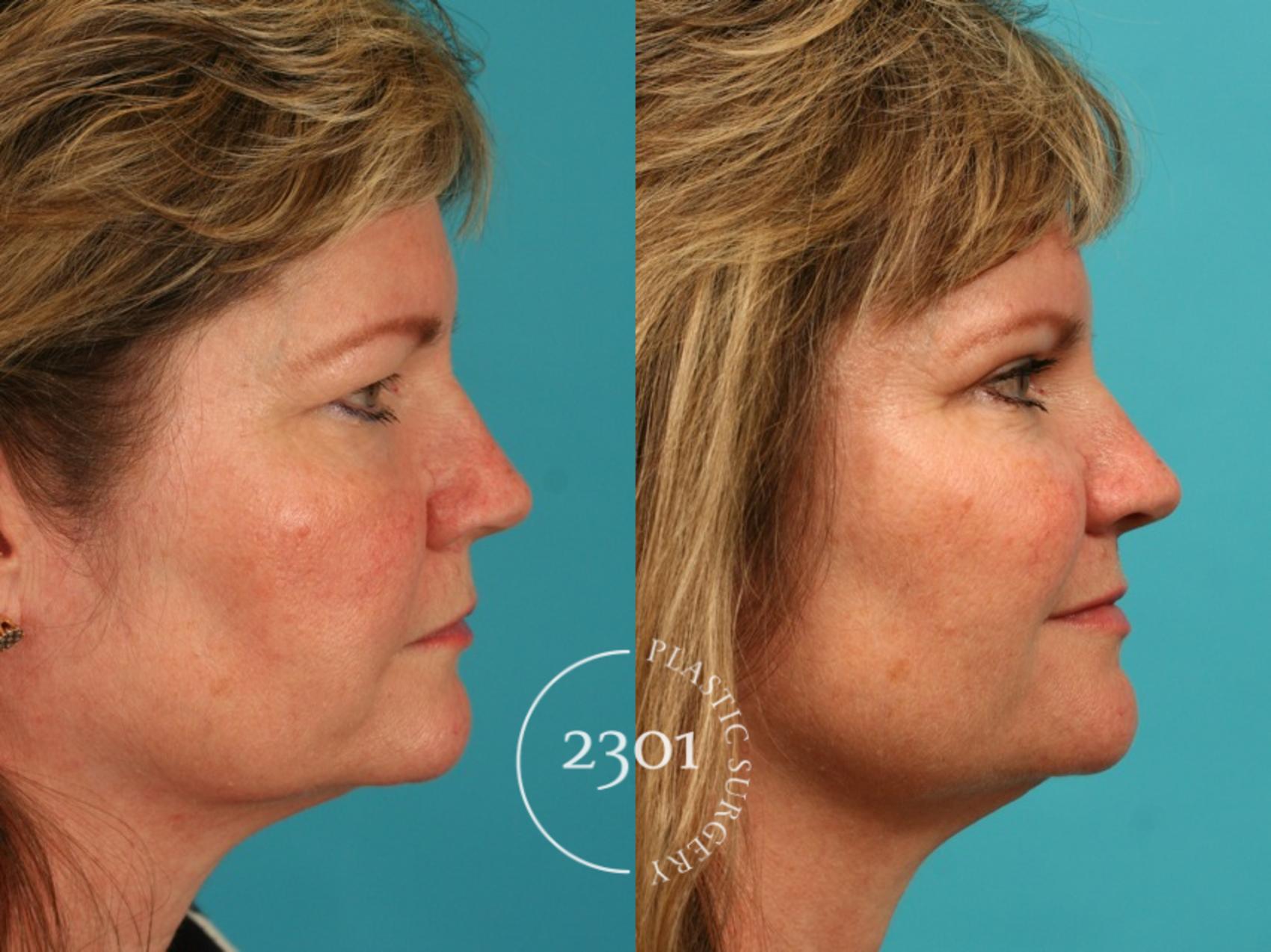 Before & After Blepharoplasty Case 55 View #2 View in Fort Worth, Plano, & Frisco, Texas
